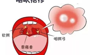 预防疱疹性咽颊炎，健康我先行