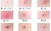 得了水痘就是出几个痘痘那么简单？